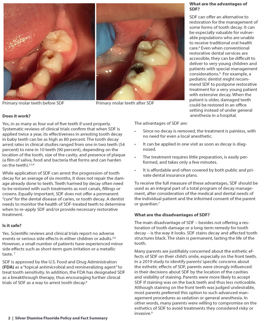 Silver Diamine Fluoride (SDF)