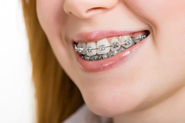 What You Need To Know About Early Orthodontic Treatment