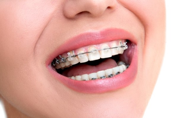 An Orthodontist Discusses How Jawbone Development Can Affect Your Smile
