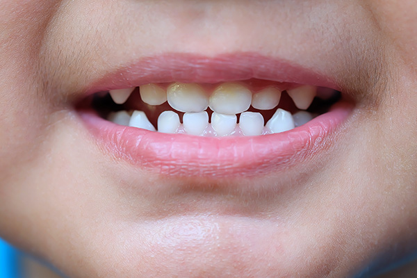 Pediatric Dental Cavity Treatment: Filling Or Crown?